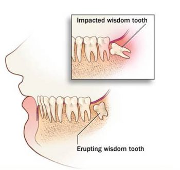 wisdom tooth removal in Punjabi Bagh