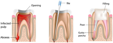 root canal treatment in Paschim Vihar