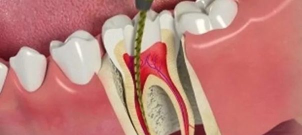 Root Canal Treatment in Punjabi Bagh