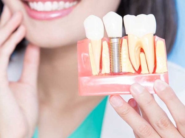 Multiple Tooth Implants in Delhi