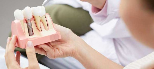 single tooth implants in Delhi