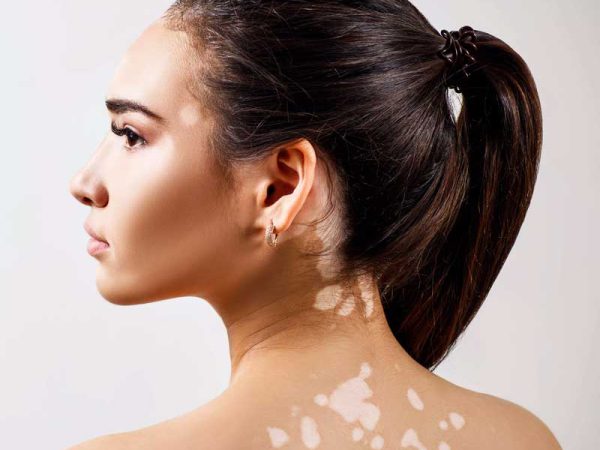 Vitiligo Treatment in Punjabi Bagh