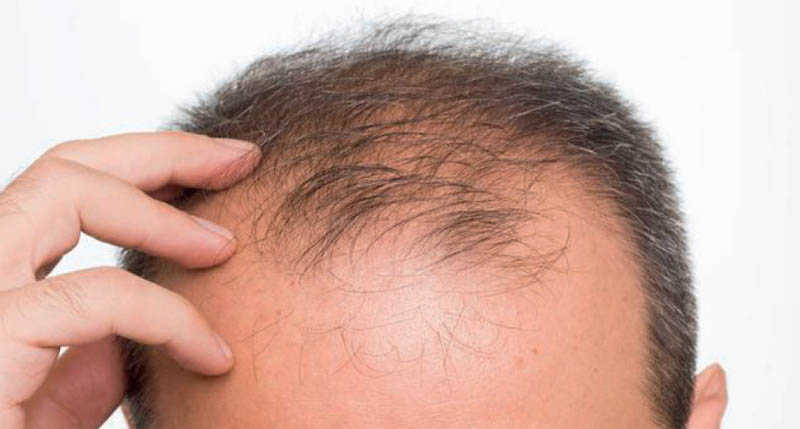 hair transplant in Punjabi Bagh