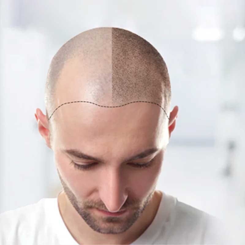 fue hair transplant in Delhi